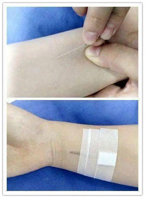 达托霉素用于哪个科室(达托霉素用什么液体配置) 达托霉素用于哪个科室(达托霉素用什么液体配置)